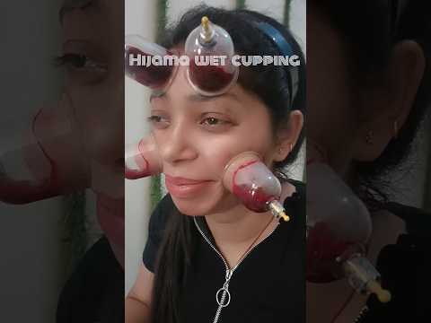 Hijama Cupping on face #acne #skincare #gym #motivation #shortreels #instashorts #dr.malikofficial