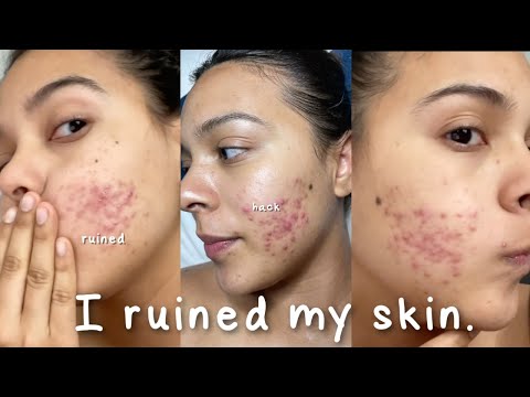I Ruined My Skin with this Beauty Hack… #shorts #skincare